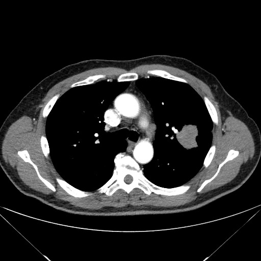 Adenocarcinoma of the lung (Radiopaedia 59871-67325 Axial C+ arterial phase 34).jpg