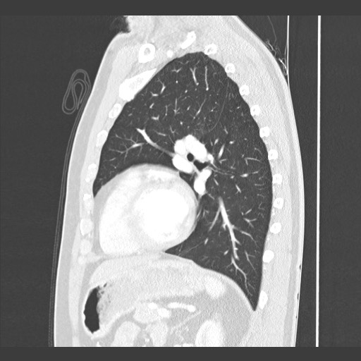 Adenocarcinoma of the lung (Radiopaedia 59871-67325 Sagittal lung window 67).jpg