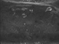 Adenocarcioma of rectum- T1 lesion (Radiopaedia 36921-38546 Axial DWI 56).png