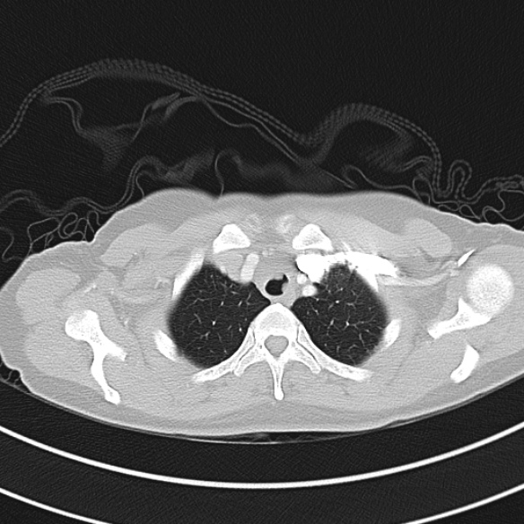 Adenocystic carcinoma of the trachea (Radiopaedia 47677-52525 Axial lung window 33).jpg
