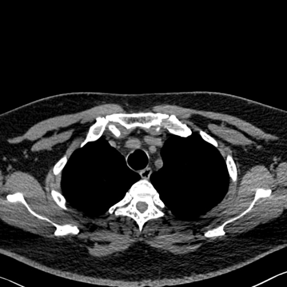 File:Adenoid cystic carcinoma of the trachea (Radiopaedia 49042-54137 Axial non-contrast 62).jpg
