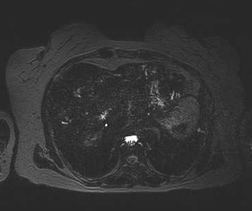 File:Adenomyomatosis of the gallbladder (Radiopaedia 50246-55587 Axial 4).png