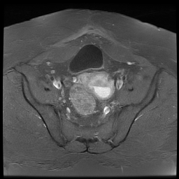 File:Adenomyosis within a didelphys uterus (Radiopaedia 70175-80215 Axial T1 C+ fat sat 23).jpg