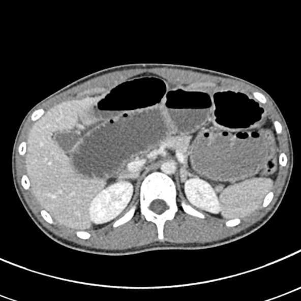 File:Adhesional small bowel obstruction (Radiopaedia 52107-57980 Axial C+ portal venous phase 31).jpg