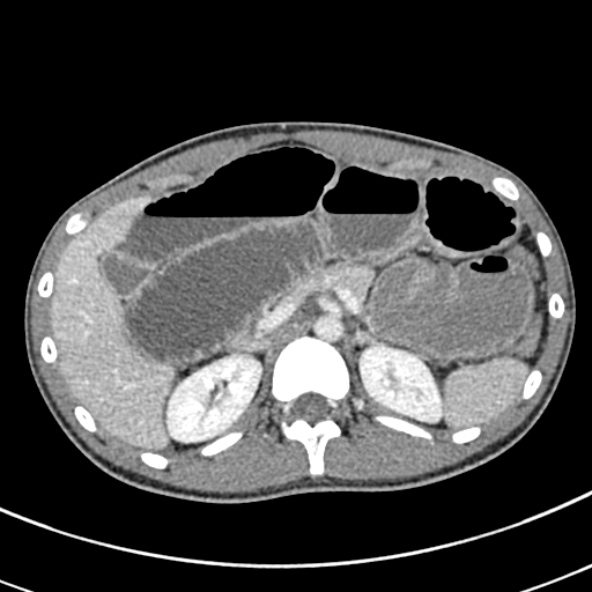 File:Adhesional small bowel obstruction (Radiopaedia 52107-57980 Axial C+ portal venous phase 33).jpg