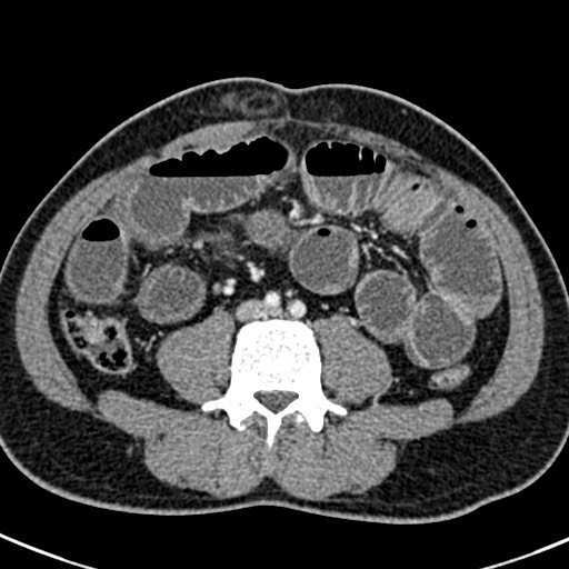 Adhesional small bowel obstruction (Radiopaedia 58900-66131 Axial C+ portal venous phase 31).jpg