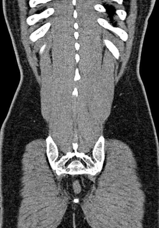 Adhesional small bowel obstruction (Radiopaedia 58900-66131 Coronal C+ portal venous phase 214).jpg