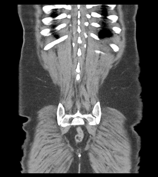 Adhesions within abdominal wall hernia (Radiopaedia 58283-65394 Coronal C+ portal venous phase 60).png