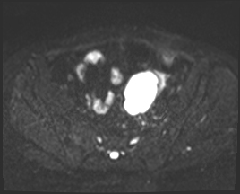 File:Adnexal multilocular cyst (O-RADS US 3. O-RADS MRI 3) (Radiopaedia 87426-103754 Axial 144).jpeg