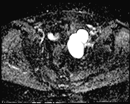 File:Adnexal multilocular cyst (O-RADS US 3. O-RADS MRI 3) (Radiopaedia 87426-103754 Axial 155).jpeg