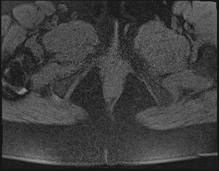 File:Adnexal multilocular cyst (O-RADS US 3. O-RADS MRI 3) (Radiopaedia 87426-103754 Axial 227).jpeg