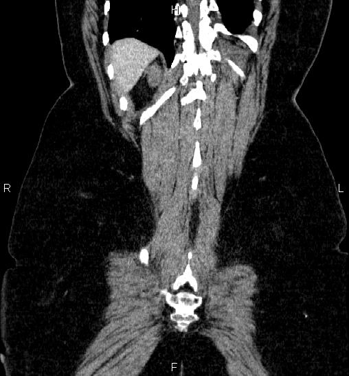 Adrenal cortical carcinoma (Radiopaedia 84882-100379 Coronal C+ portal venous phase 58).jpg