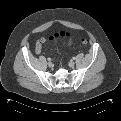 File:Adrenal cyst (Radiopaedia 45625-49776 Axial C+ portal venous phase 75).png