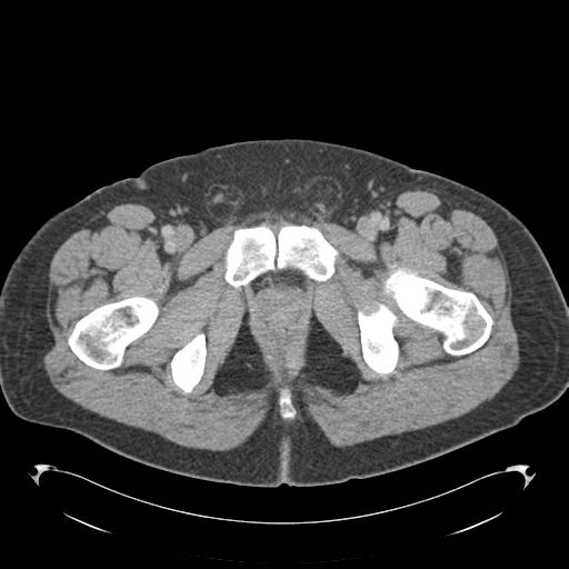 Adrenal cyst (Radiopaedia 45625-49776 Axial C+ portal venous phase 99).png