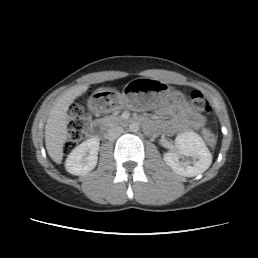 Adrenal cyst (Radiopaedia 64869-73813 Axial C+ portal venous phase 34).jpg