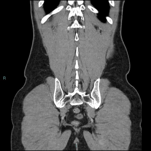 Adrenal cystic lymphangioma (Radiopaedia 83161-97534 Coronal C+ portal venous phase 66).jpg