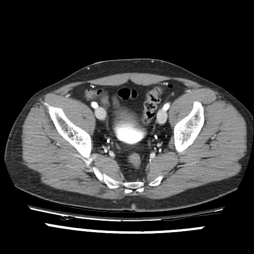 Adrenal gland trauma (Radiopaedia 81351-95078 Axial Dual bolus trauma C+ 109).jpg
