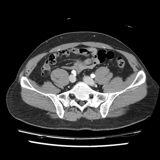 Adrenal gland trauma (Radiopaedia 81351-95078 Axial Dual bolus trauma C+ 98).jpg