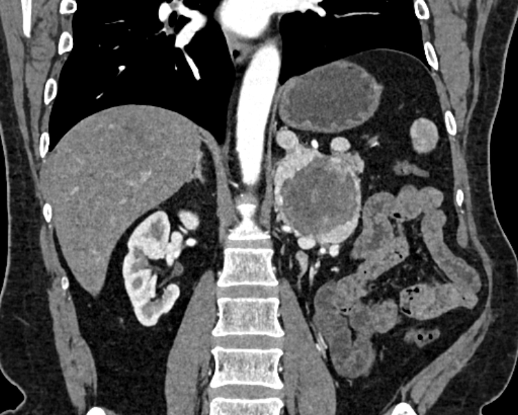 File:Adrenal metastases (Radiopaedia 73082-83791 Coronal C+ arterial phase 39).jpg