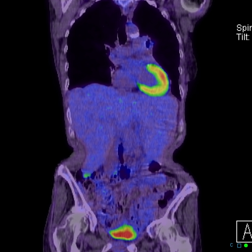 File:Adrenal metastasis from small cell lung cancer (Radiopaedia 19133-19109 Coronal 10).jpg