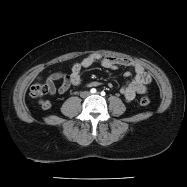 Adrenal myelolipoma (Radiopaedia 43401-46759 Axial C+ arterial phase 64).jpg