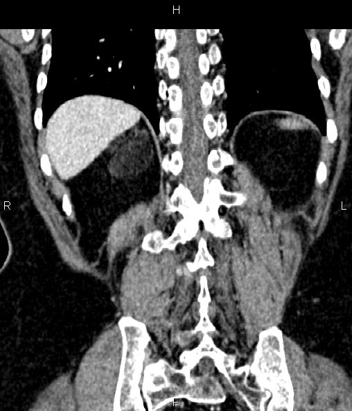 Adrenal myelolipoma (Radiopaedia 82742-96986 Coronal renal cortical phase 61).jpg