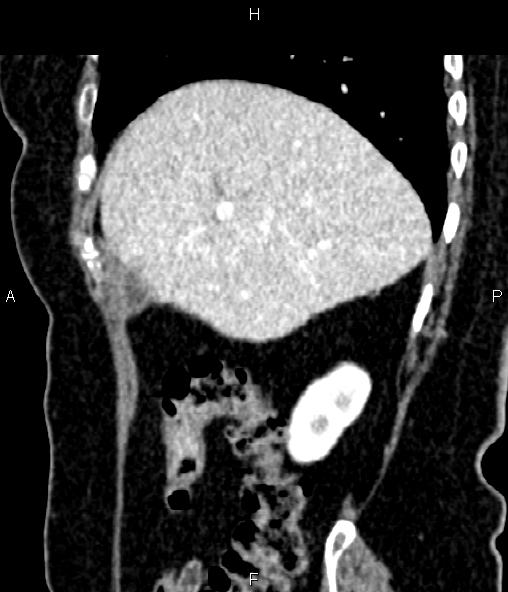 Adrenal myelolipoma (Radiopaedia 82742-96986 Sagittal renal cortical phase 30).jpg