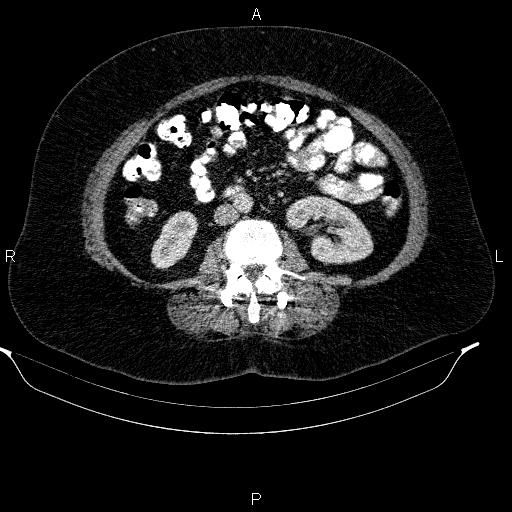 Adrenal myelolipoma (Radiopaedia 84319-99617 Axial renal cortical phase 59).jpg