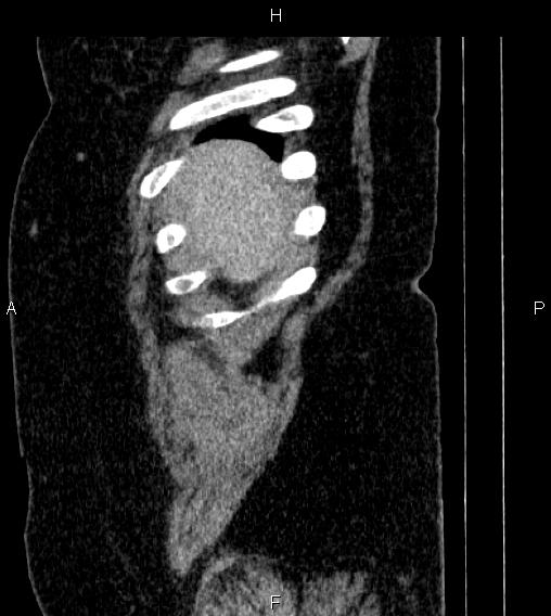 Adrenal myelolipoma (Radiopaedia 84319-99617 Sagittal renal cortical phase 4).jpg