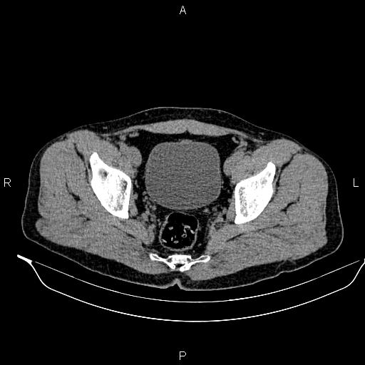 Adrenal myelolipoma (Radiopaedia 87794-104246 Axial non-contrast 95).jpg