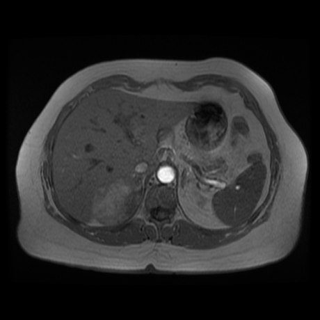 File:Adrenal myelolipoma - MRI (Radiopaedia 83249-97646 Axial T1-in phase 6).jpg