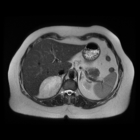 File:Adrenal myelolipoma - MRI (Radiopaedia 83249-97646 Axial T2 12).jpg