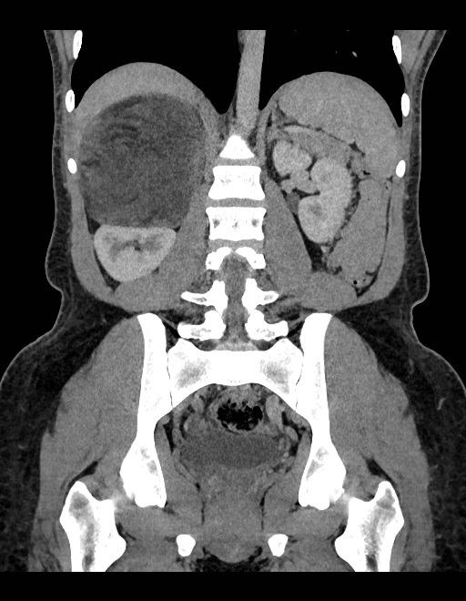 Adrenal myelolipoma - bilateral (Radiopaedia 74805-85810 Coronal C+ portal venous phase 122).jpg