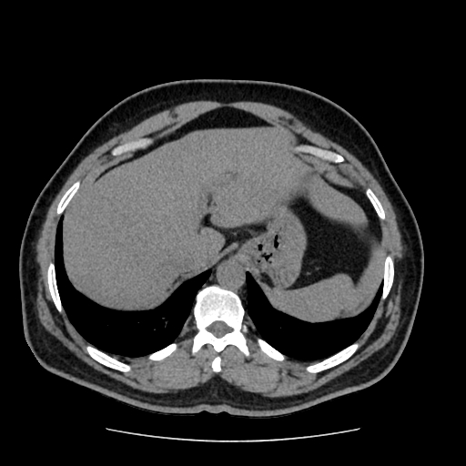 Adrenal myelolipoma and beaver tail liver (Radiopaedia 86201-102193 Axial non-contrast 77).jpg