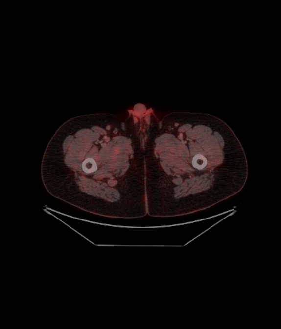 Adrenocortical carcinoma (Radiopaedia 80134-93440 ِAxial 272).jpg