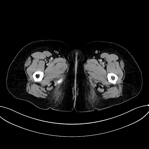 Adrenocortical carcinoma (Radiopaedia 87281-103569 Axial C+ portal venous phase 96).jpg