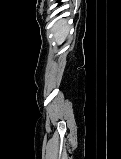 Adrenocortical carcinoma (Radiopaedia 87281-103569 Sagittal C+ portal venous phase 4).jpg