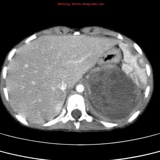 File:Adrenocortical carcinoma (Radiopaedia 9449-10131 Axial C+ portal venous phase 10).jpg
