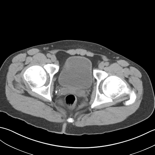 File:Adult polycystic kidney disease (Radiopaedia 47866-52626 Axial non-contrast 81).png