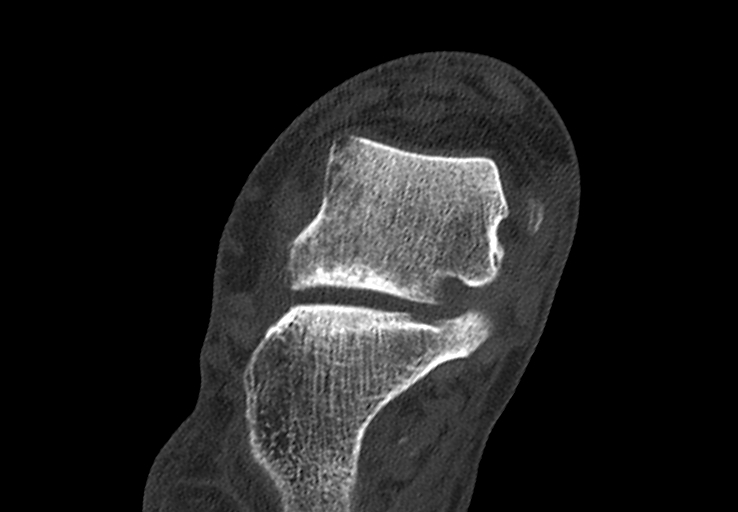 Advanced osteomyelitis due to open metatarsal fracture (Radiopaedia 83891-99095 Axial bone window 8).jpg