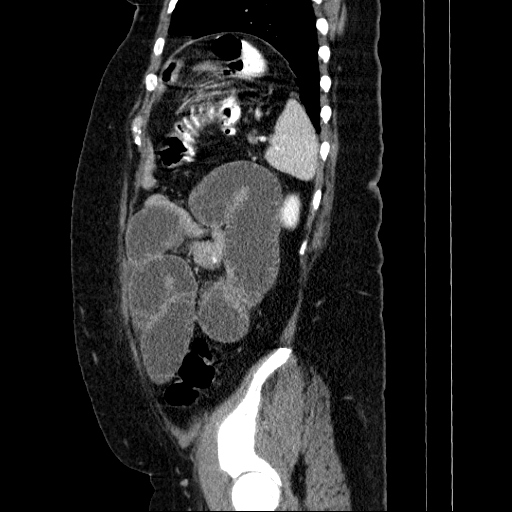 File:Afferent loop syndrome - secondary to incarcerated trocar site hernia (Radiopaedia 82959-97305 Sagittal C+ portal venous phase 33).jpg