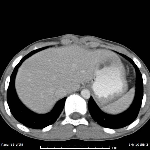 File:Agenesis of the gallbladder (Radiopaedia 55454-61905 Axial 35).jpg