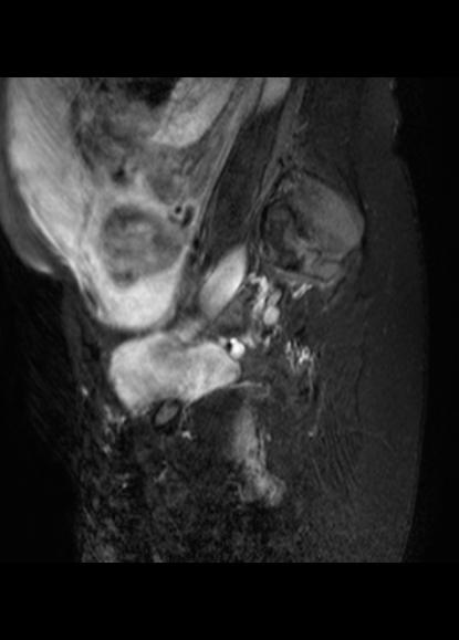 File:Aggressive angiomyxoma of the pelvis and perineum (Radiopaedia 59162-66479 Sagittal T2 fat sat 3).jpg