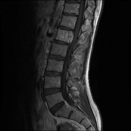 File:Aggressive vertebral hemangioma with pathological fracture (Radiopaedia 69528-79411 Sagittal T1 C+ 6).jpg