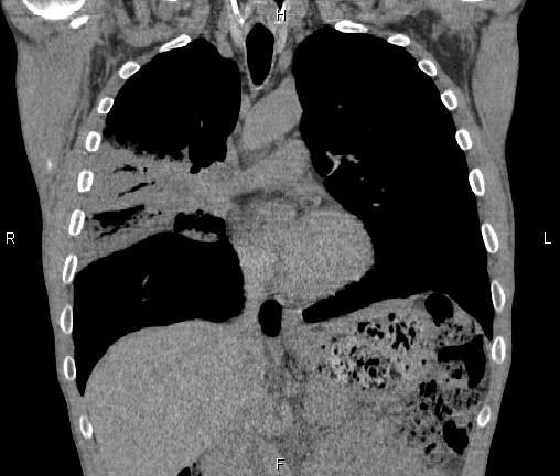 Air bronchogram in pneumonia (Radiopaedia 85719-101512 Coronal non-contrast 26).jpg