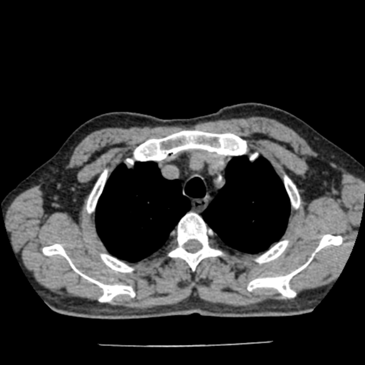 Airway foreign body in adult (Radiopaedia 85907-101779 Axial liver window 16).jpg