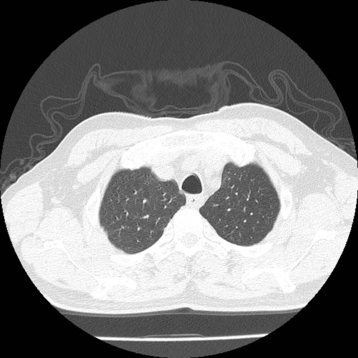 Airway foreign body in adult (Radiopaedia 85907-101779 Axial lung window 11).jpg