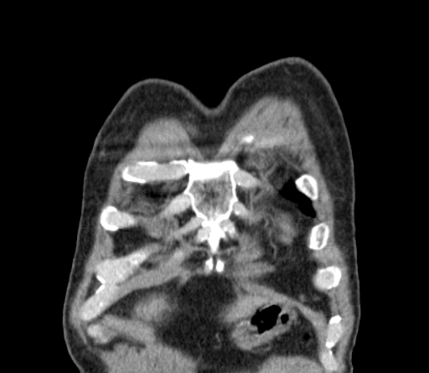 Airway foreign body in adult (Radiopaedia 85907-101779 Coronal liver window 11).jpg
