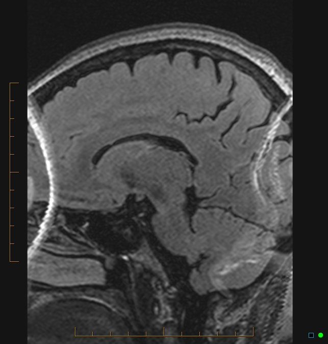 Aliasing artifact causing a spurious cerebellar lesion (Radiopaedia 48783-53810 Sagittal FLAIR 62).jpg