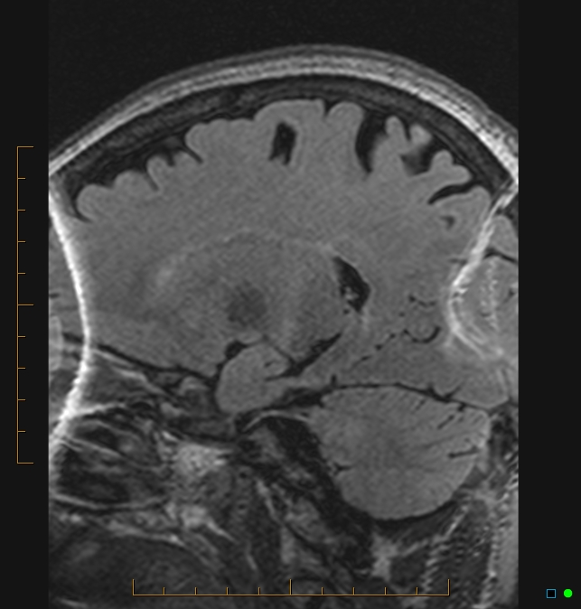 Aliasing artifact causing a spurious cerebellar lesion (Radiopaedia 48783-53810 Sagittal FLAIR 74).jpg